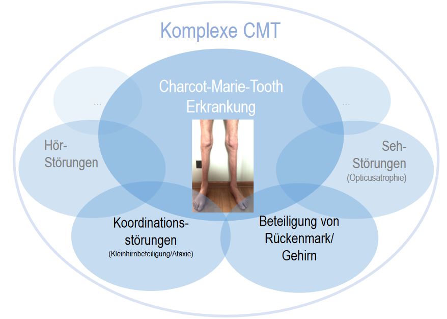 Grafik Charcot-Marie-Tooth Erkrankung